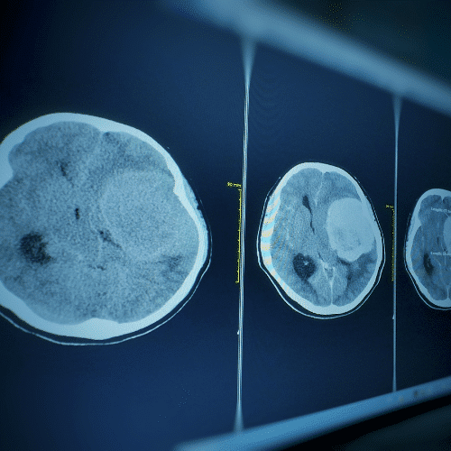 Brain Conditions We Treat