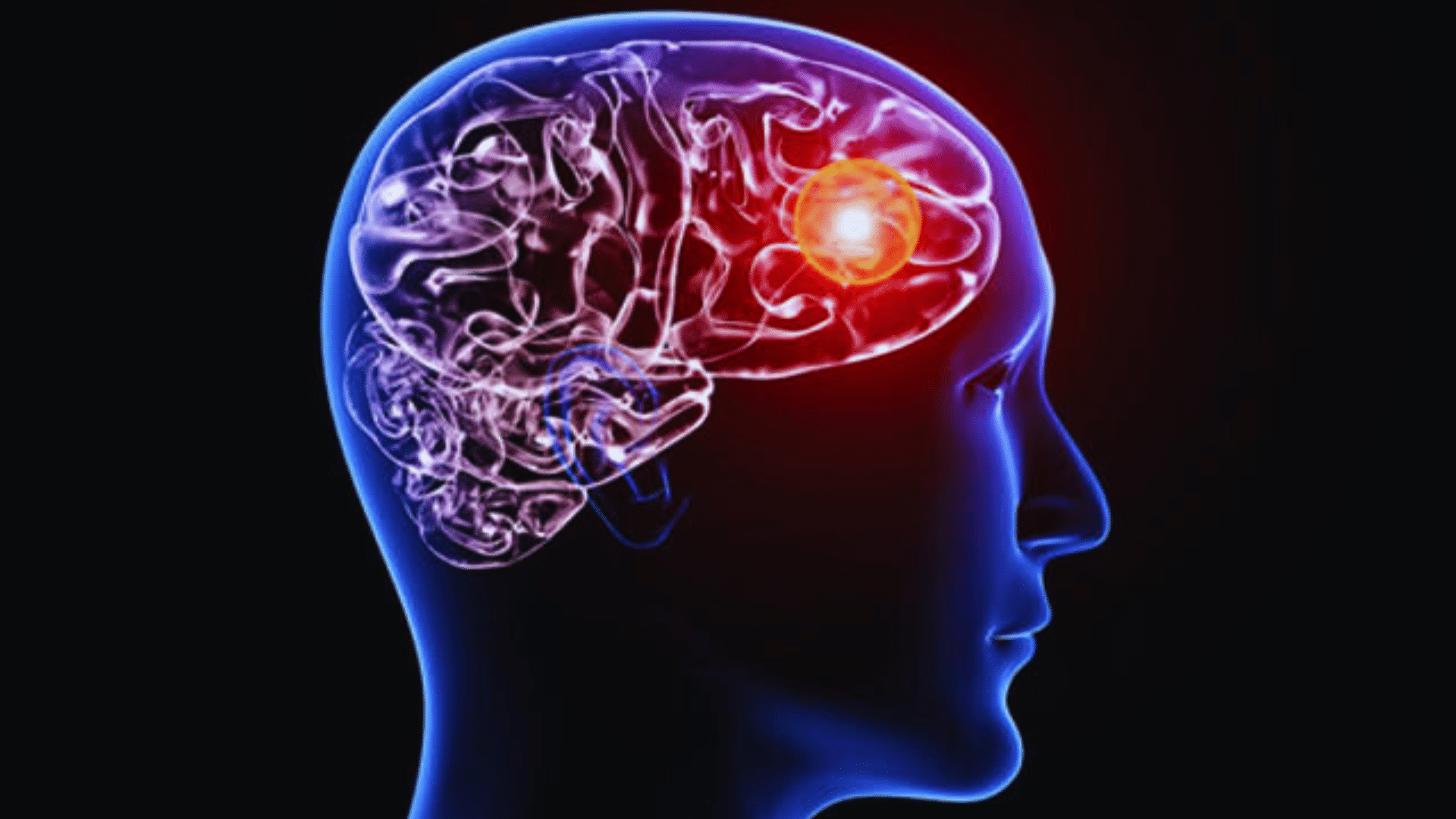 Brain Aneurysm
Embolization