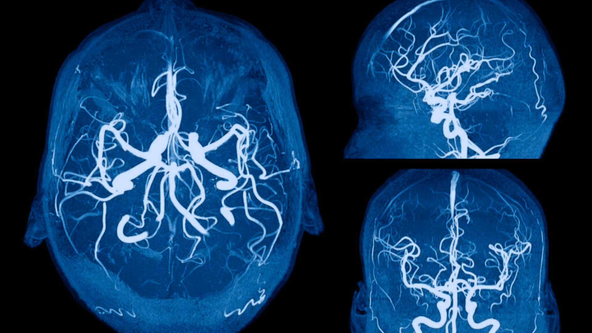 Cerebral
Angiogram