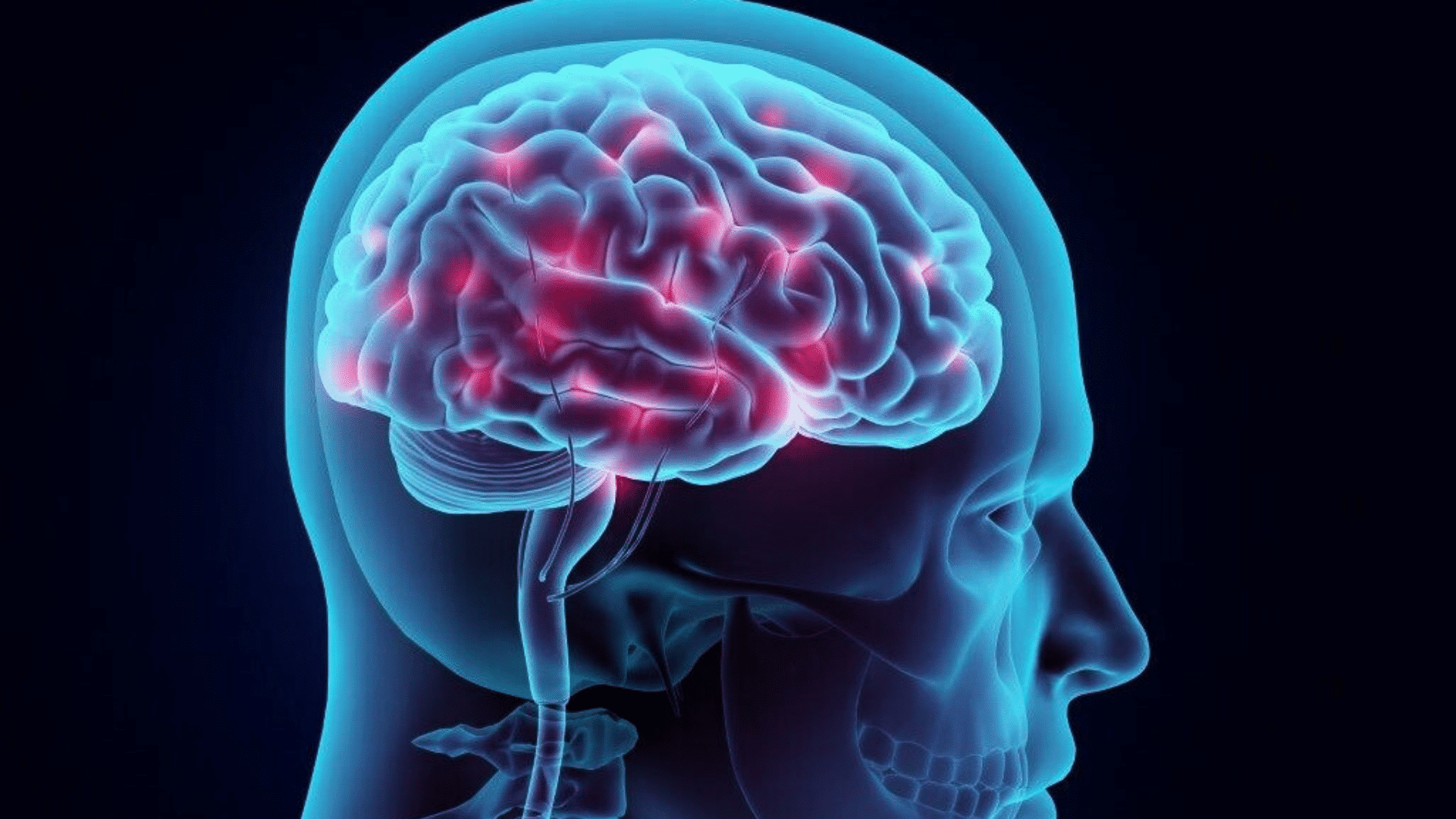 Cerebral Hemorrhage