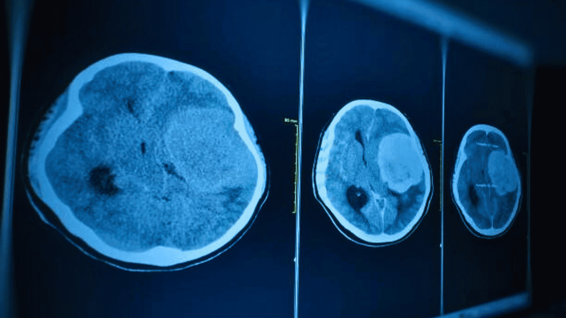 Embolization for
Subdural Hematoma Treatment