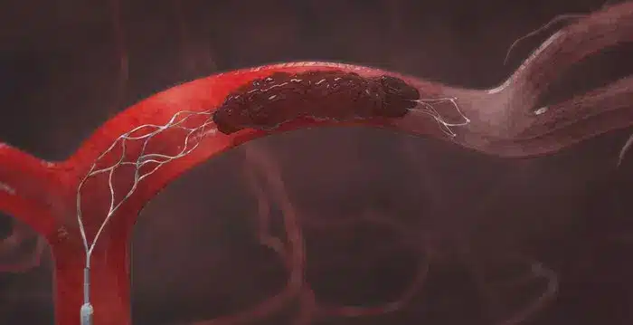 Acute Ischemic Stroke Intervention Image