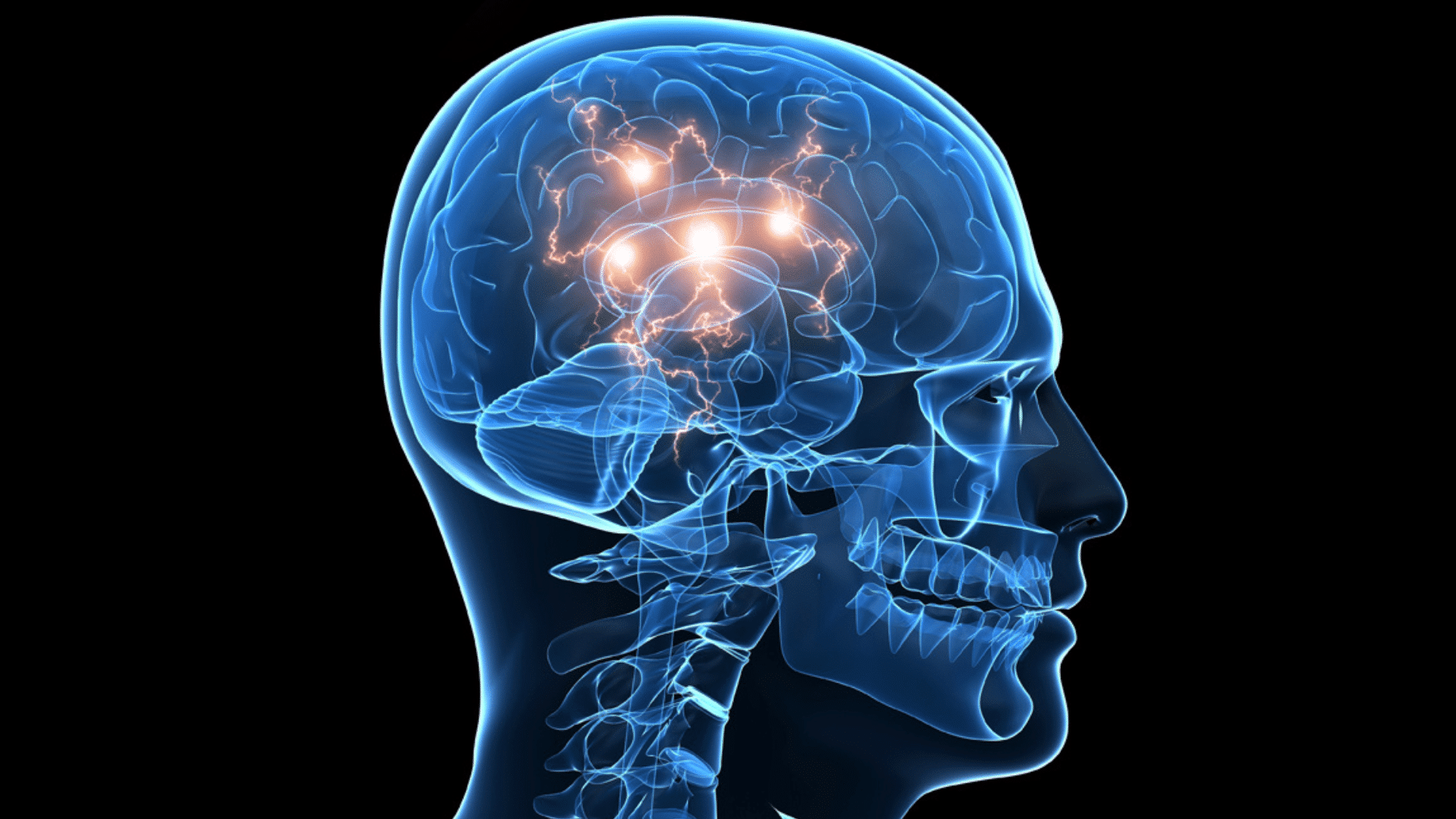 Stroke