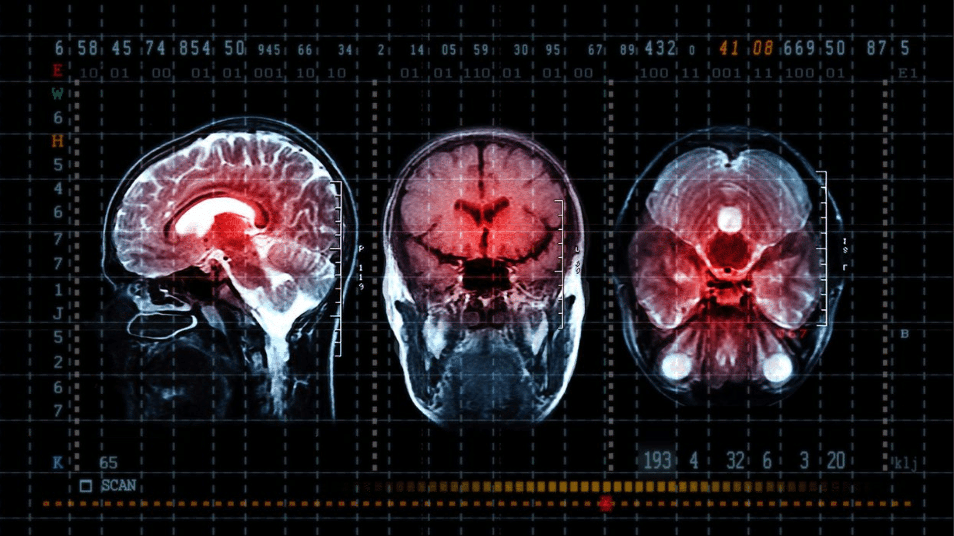 Subarachnoid Hemorrhage