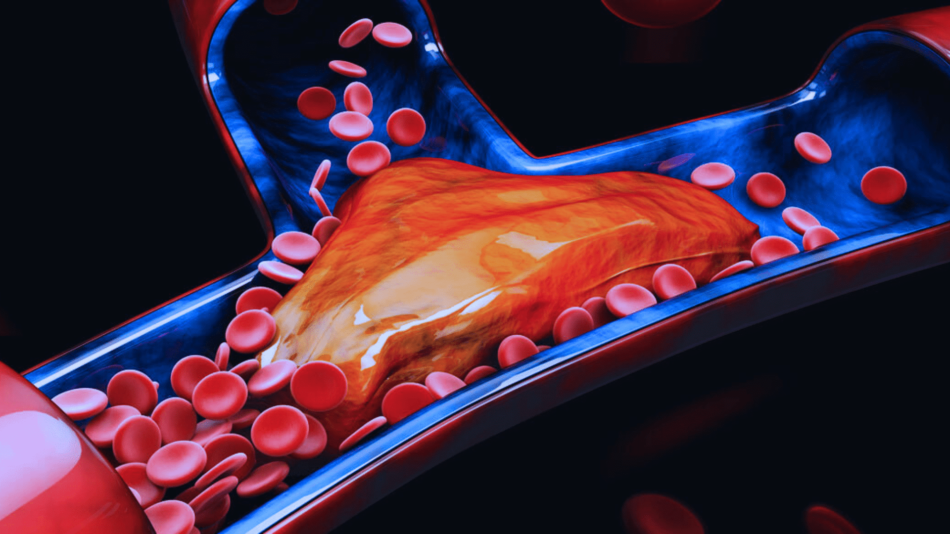 Thrombectomy
for Stroke