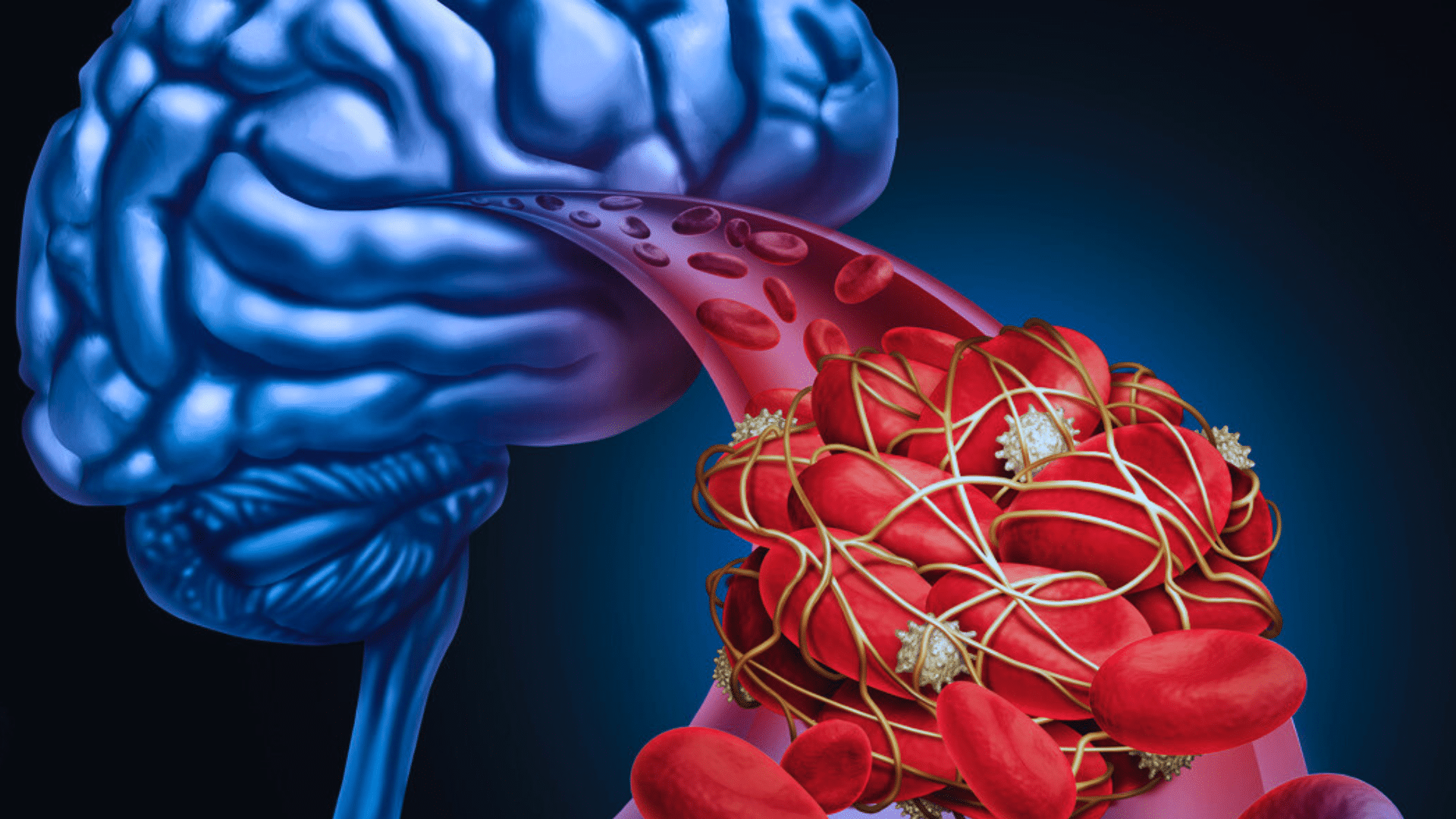 Transient Ischemic Attack