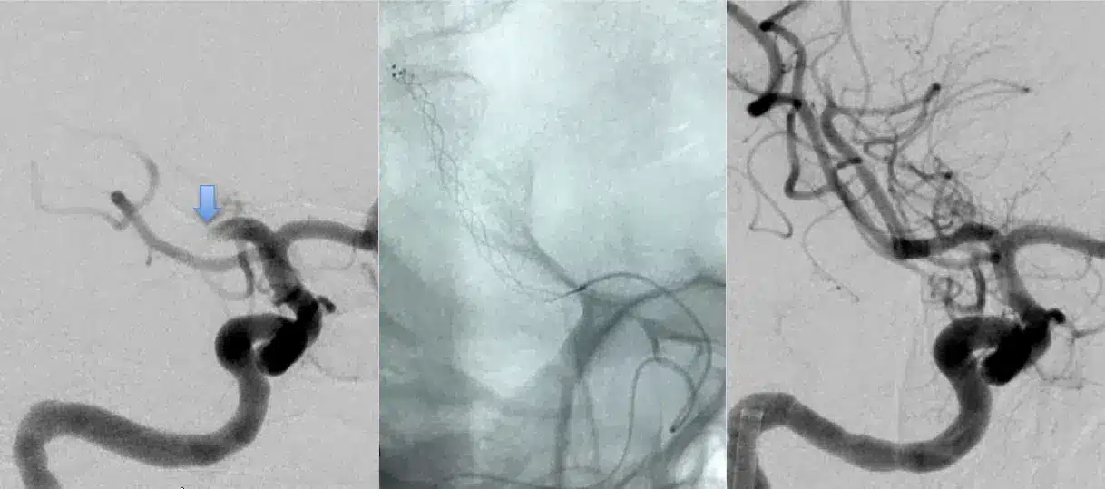 Acute Ischemic Stroke Intervention Image