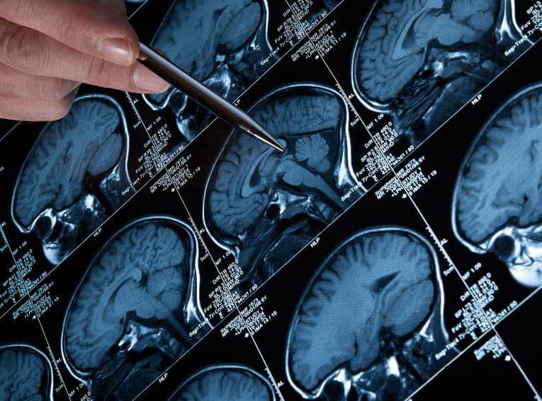 Cerebrovascular
Neurosurgery