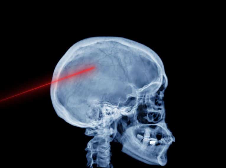 Hydrocephalus and
Shunt Procedures