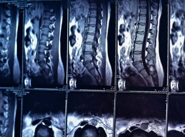 Minimally Invasive
Robotic Spine Surgery